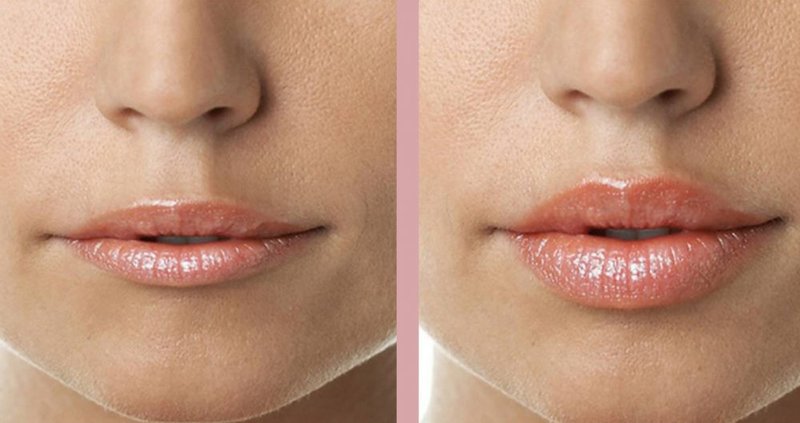 Lūpos prieš ir po lūpų kontūravimo su hialurono rūgštimi