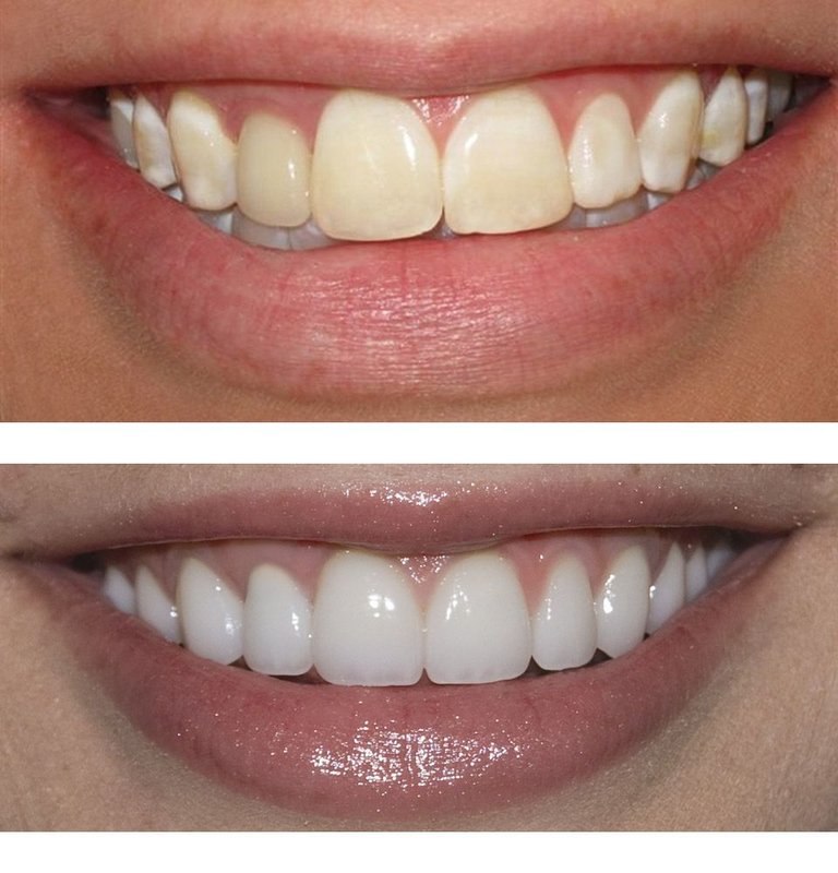 Perfekte smilefiner: før og etter