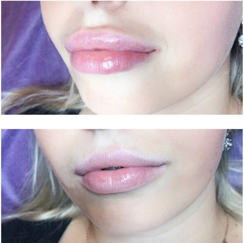 Zwelling van de lippen na vergroting van hyaluronzuur
