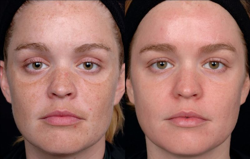 Преди и след лазерно почистване на лицето