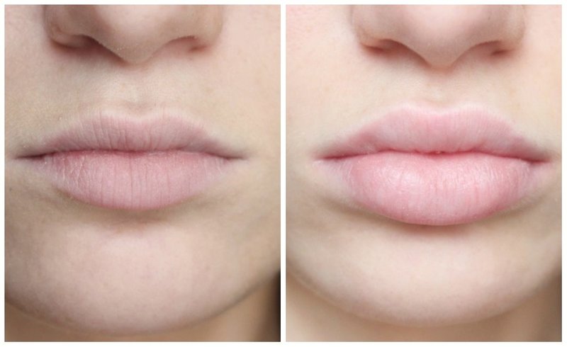 Увеличаване на устните с хиалуронова киселина
