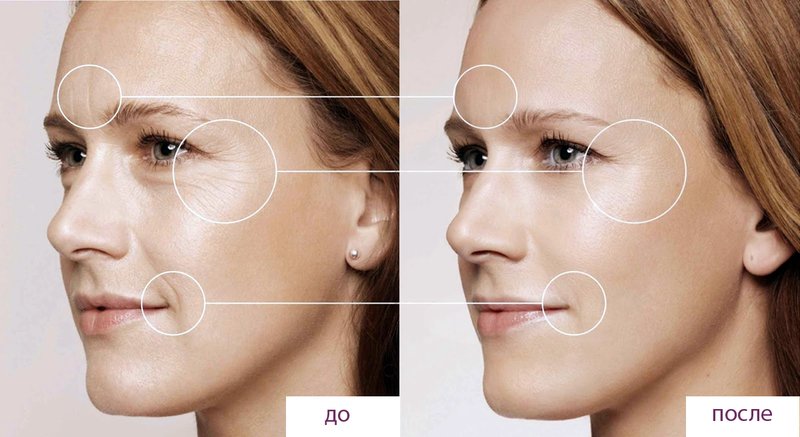 Wynik przed i po biorewitalizacji twarzy