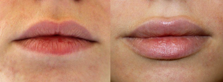 Augmentation des lèvres avec acide hyaluronique