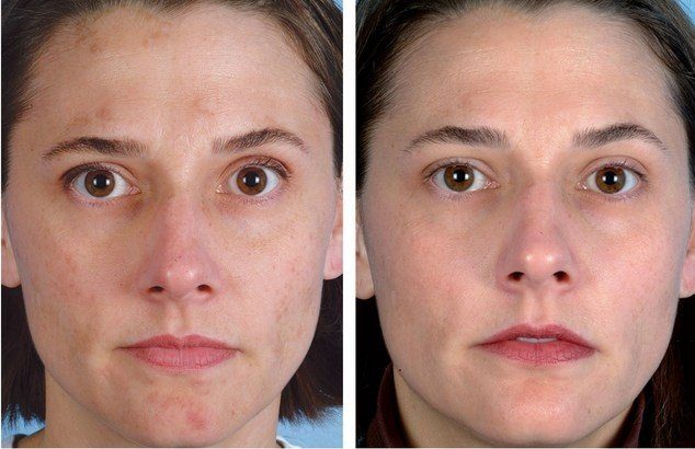Před a po vakuovém čištění obličeje