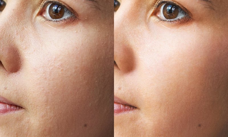 Före och efter ultraljudsrengöring i ansiktet