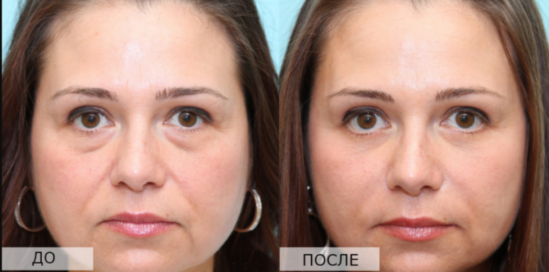 Ultragarsinis veido pakėlimas