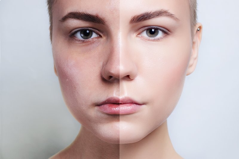 Przed i po oczyszczeniu twarzy
