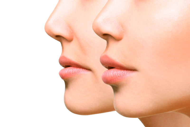 Usta przed i po nałożeniu wypełniaczy