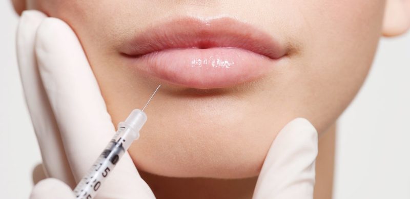 Hyaluronzuur injectie in de lippen