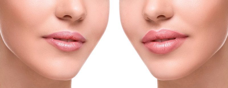 Lippen vergrote vulstoffen (voor en na)