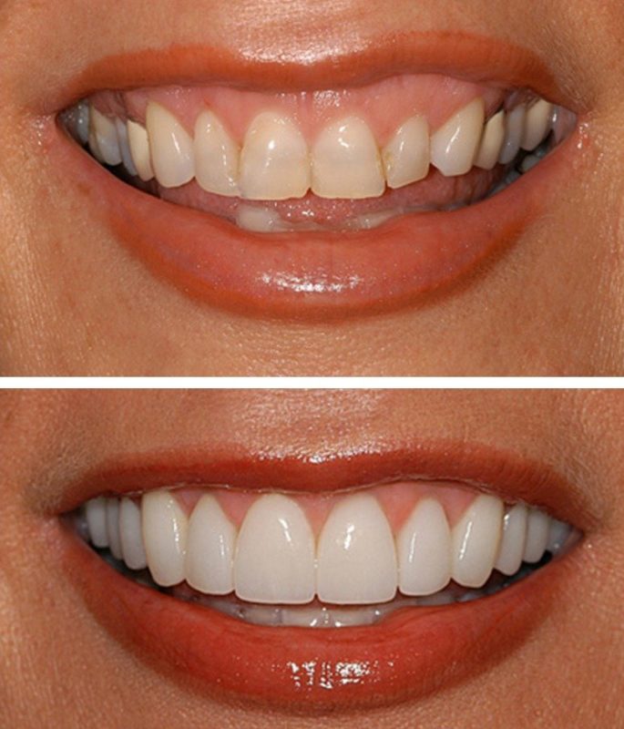Perfect Smile Veneers Veneers: Before and After