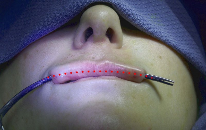 Installation d'implants dans les lèvres