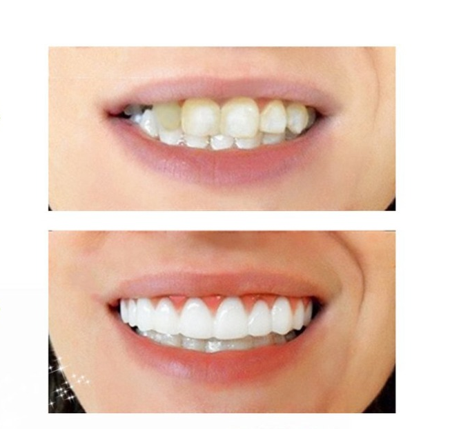 Perfect Smile Veneers: Avant et après