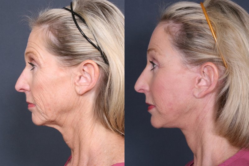 Circulaire facelift