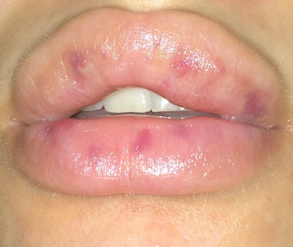 Blauwe plekken na lipvergroting