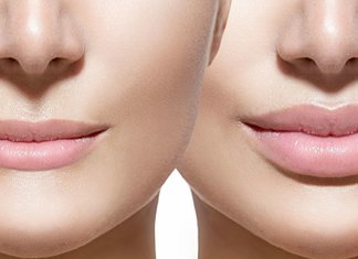 Lipvergroting: wat gebeurt er na de procedure?