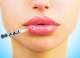 Augmentation des lèvres avec acide hyaluronique