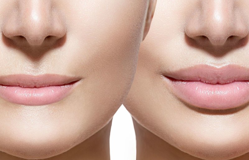 Usta przed i po powiększeniu kwasem hialuronowym