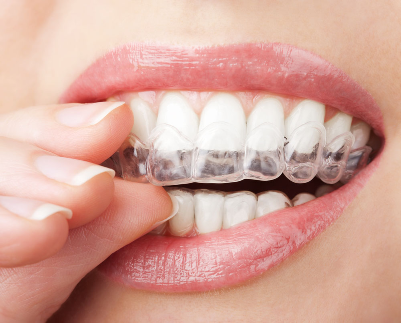 Chrániče zubov na bielenie úst