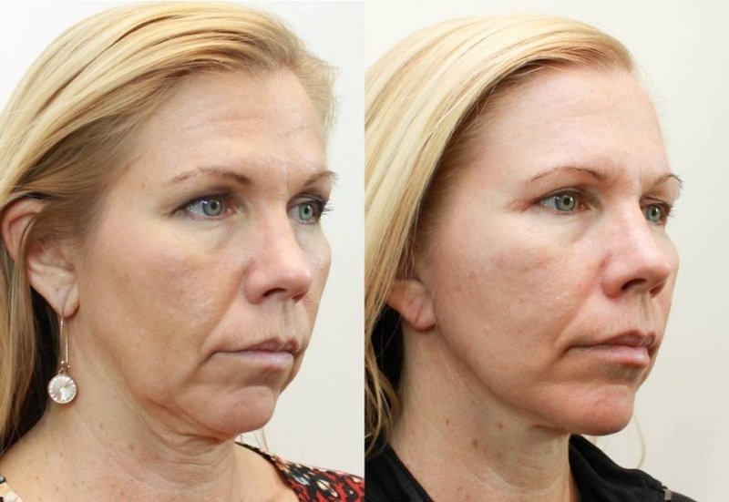 Лице преди и след биоревитализация