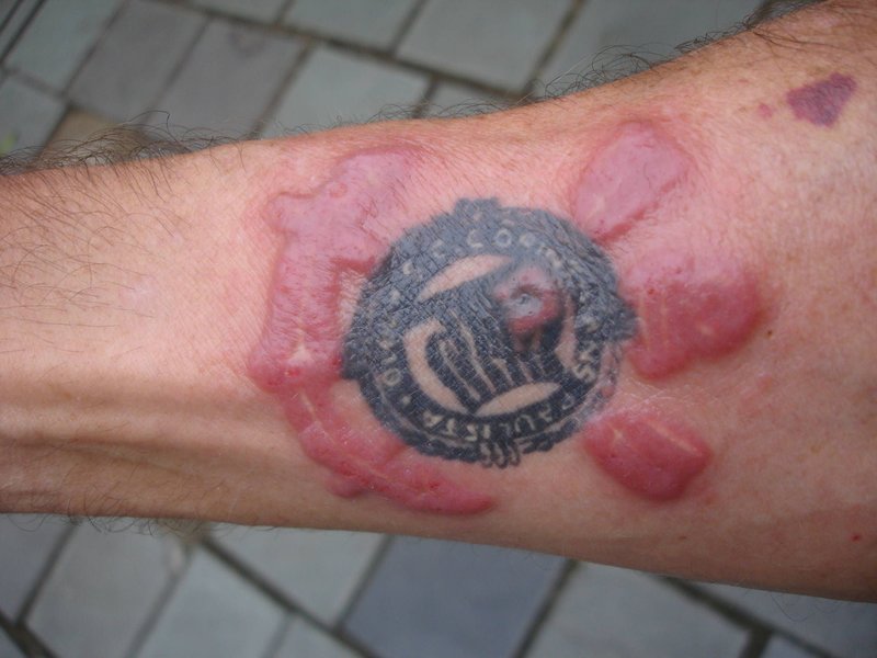 Zánět kůže po odstranění tetování