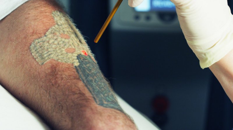 Laserowy efekt usuwania tatuaży