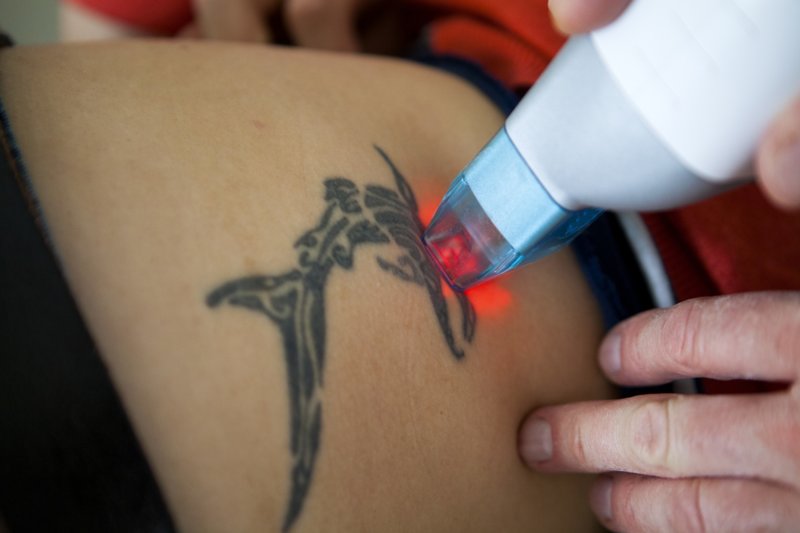 Prosess for fjerning av laser tatovering