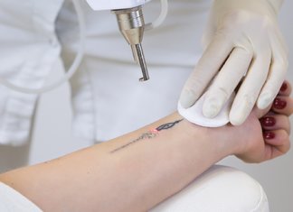 Laserové odstranění tetování