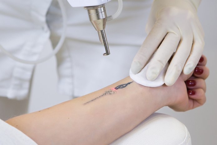 Tatuiruočių pašalinimas lazeriu