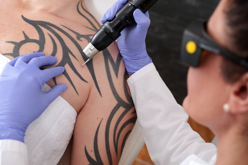 Лазерно премахване на татуировка