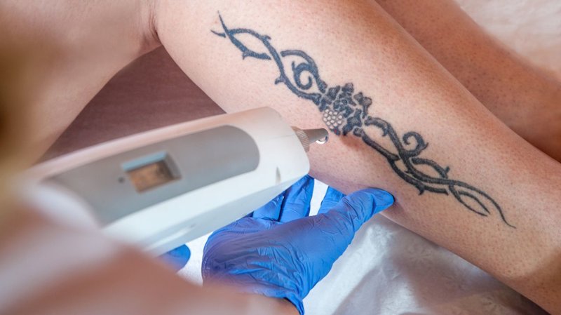 Proces odstraňování tetování
